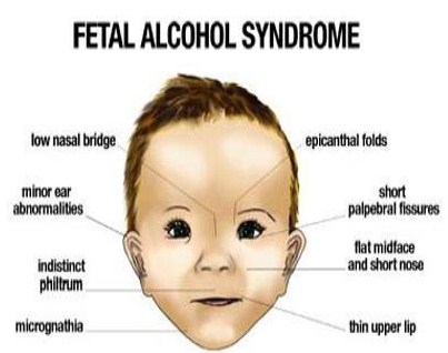 Fetal alcohol spectrum disorders + facial + pictures I squirt when i orgasm